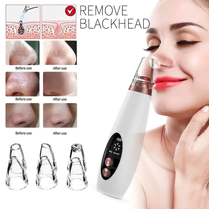The Ultimate Blackhead Remover